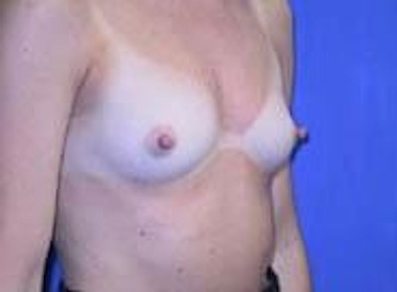 Breast Augmentation Before & After Gallery - Patient 90006536 - Image 5