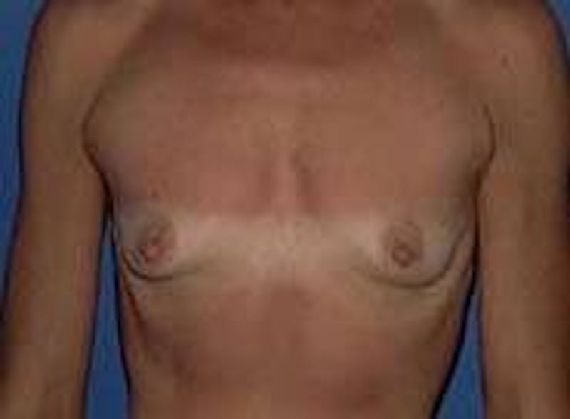 Breast Augmentation Before & After Gallery - Patient 90006537 - Image 1