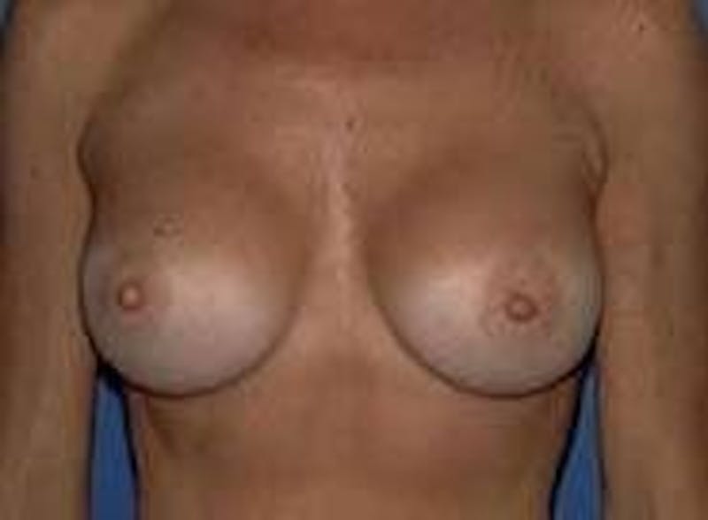 Breast Augmentation Before & After Gallery - Patient 90006537 - Image 2