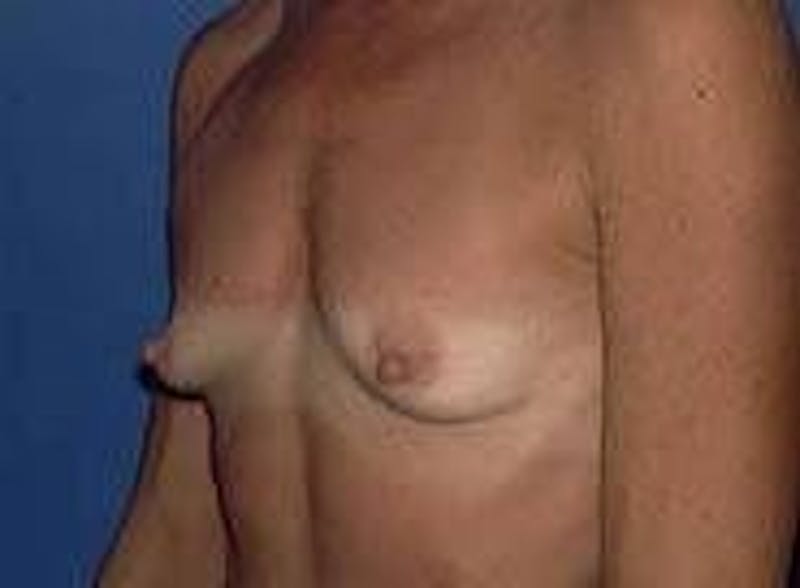 Breast Augmentation Before & After Gallery - Patient 90006537 - Image 3