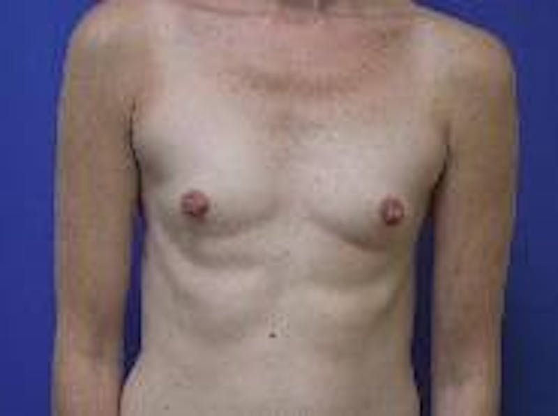 Breast Augmentation Gallery - Patient 90006538 - Image 1