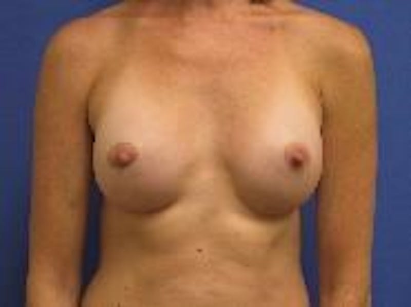 Breast Augmentation Before & After Gallery - Patient 90006538 - Image 2