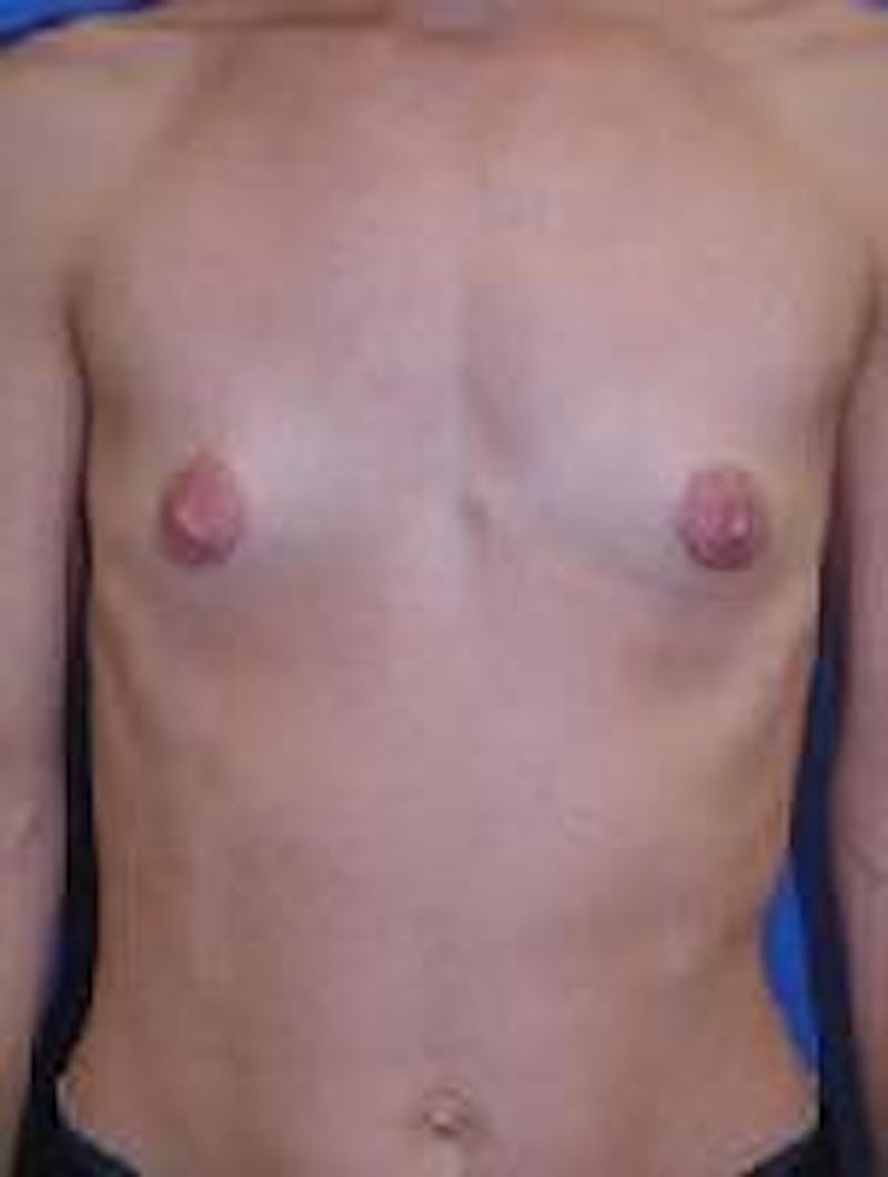 Breast Augmentation Before & After Gallery - Patient 90006540 - Image 1