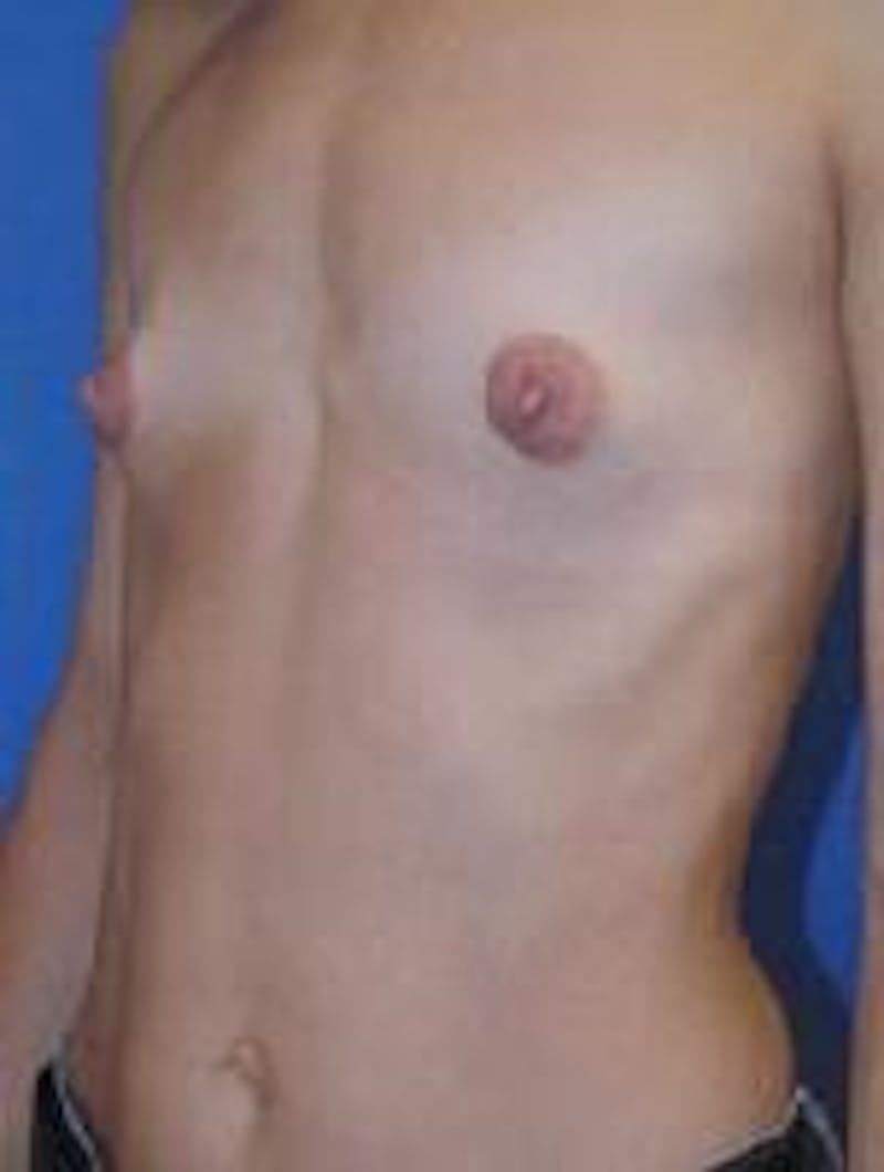 Breast Augmentation Before & After Gallery - Patient 90006540 - Image 3