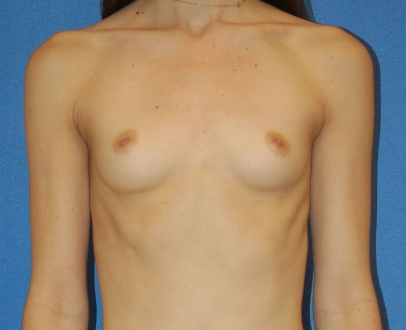 Breast Augmentation Before & After Gallery - Patient 90006569 - Image 1
