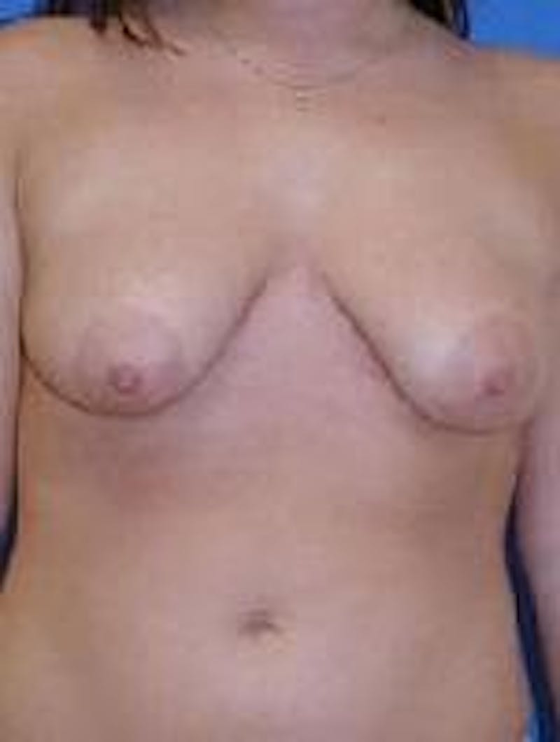 Breast Augmentation Before & After Gallery - Patient 90006581 - Image 1