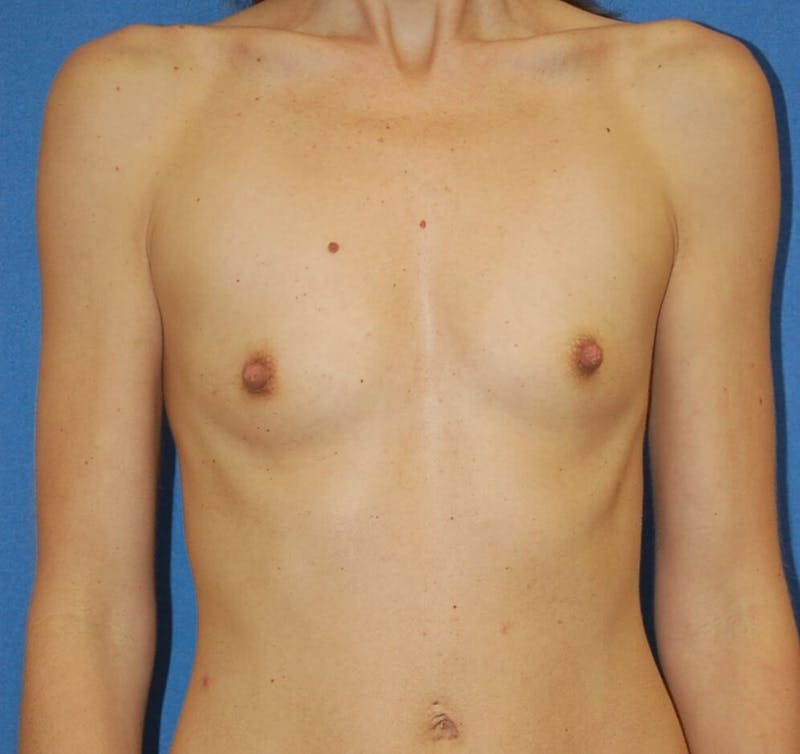 Breast Augmentation Before & After Gallery - Patient 90006587 - Image 1