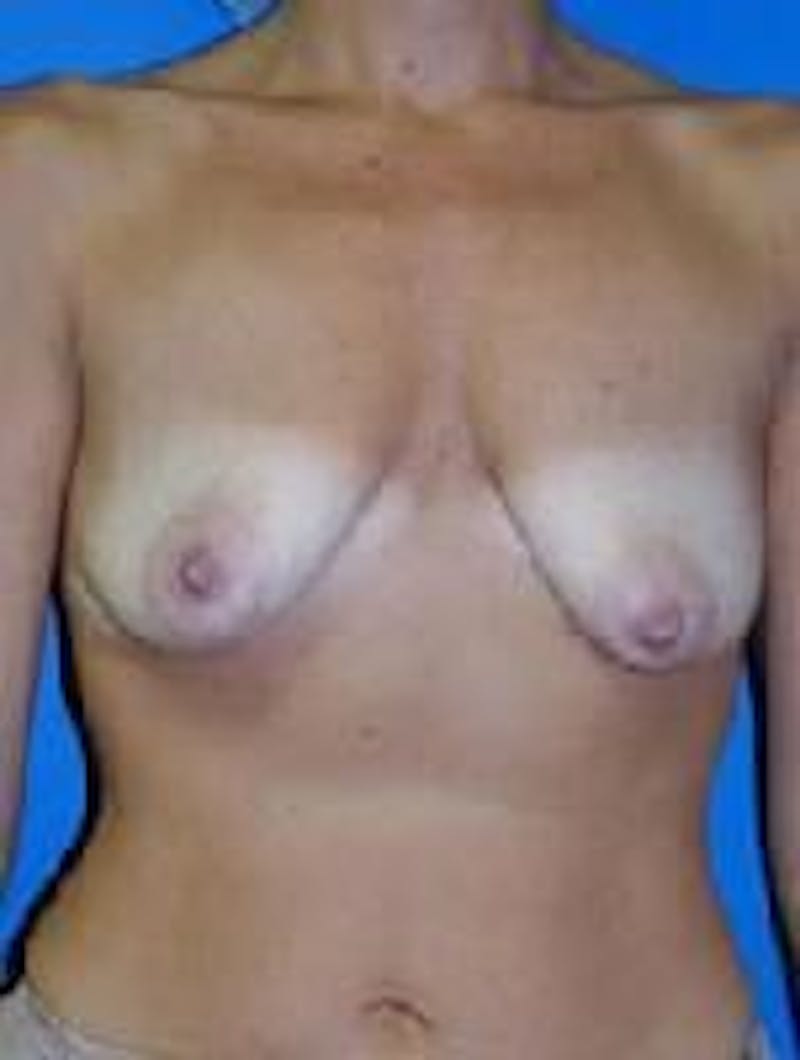 Breast Augmentation Before & After Gallery - Patient 90006598 - Image 1