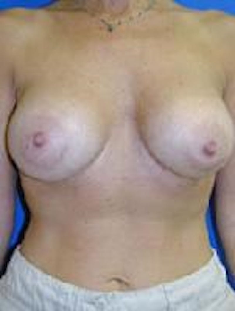 Breast Augmentation Before & After Gallery - Patient 90006598 - Image 2