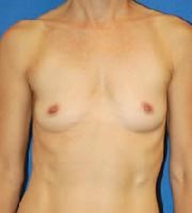 Breast Augmentation Before & After Gallery - Patient 90006615 - Image 1