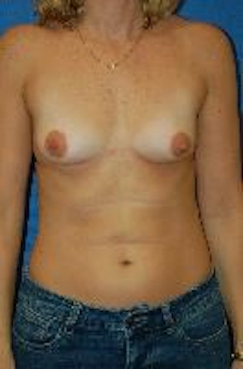 Breast Augmentation Before & After Gallery - Patient 90006616 - Image 1