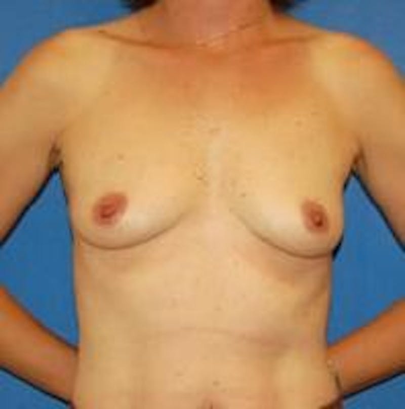 Breast Augmentation Before & After Gallery - Patient 90006620 - Image 1