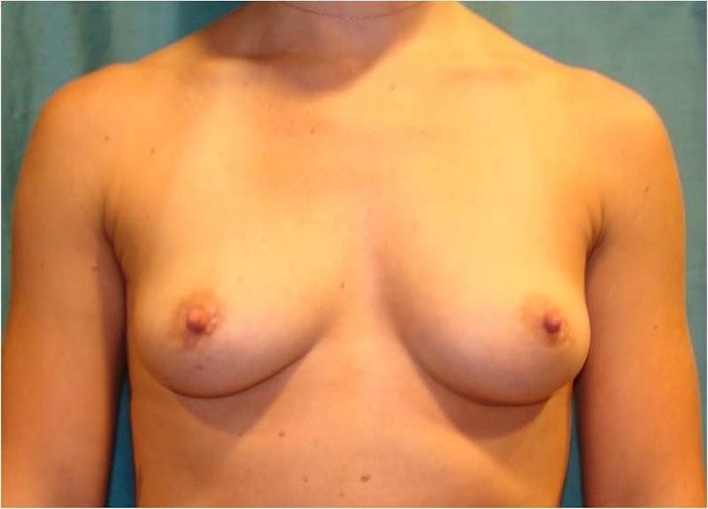Breast Augmentation Before & After Gallery - Patient 90006623 - Image 1