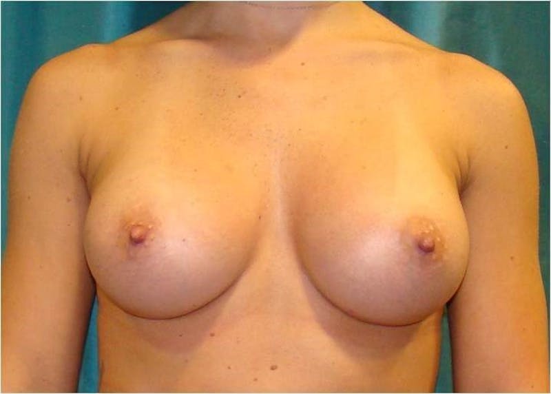Breast Augmentation Gallery - Patient 90006623 - Image 2
