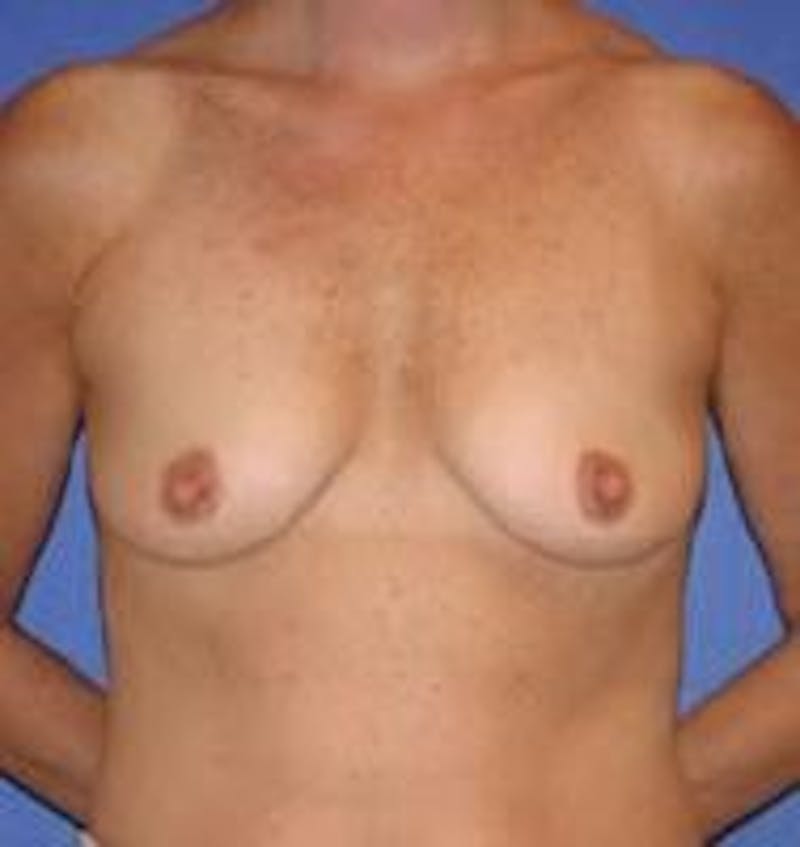 Breast Augmentation Before & After Gallery - Patient 90006624 - Image 1