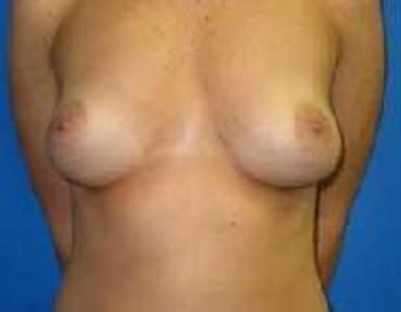 Breast Augmentation Before & After Gallery - Patient 90006627 - Image 1