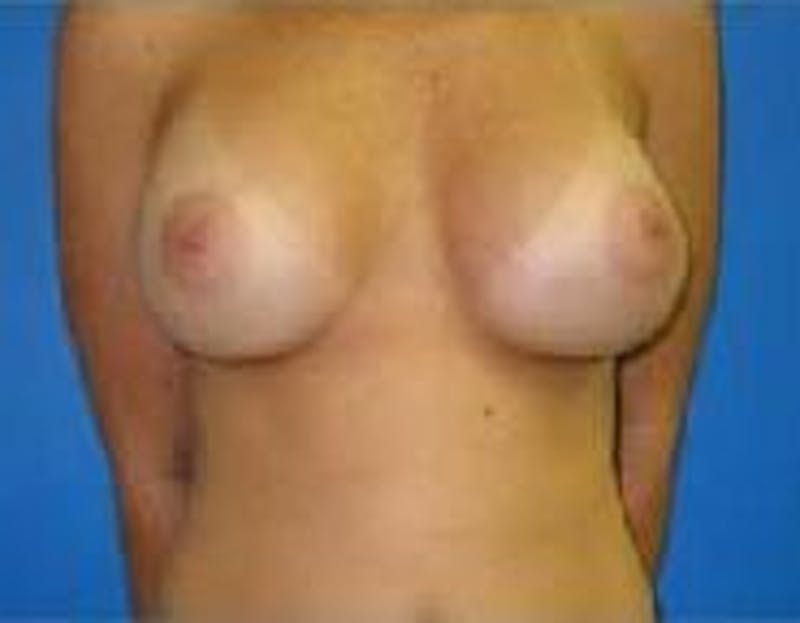 Breast Augmentation Before & After Gallery - Patient 90006627 - Image 2