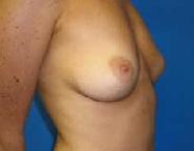 Breast Augmentation Before & After Gallery - Patient 90006627 - Image 3
