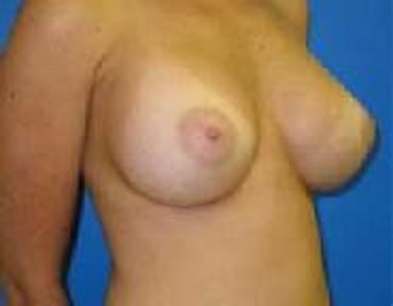 Breast Augmentation Before & After Gallery - Patient 90006627 - Image 4