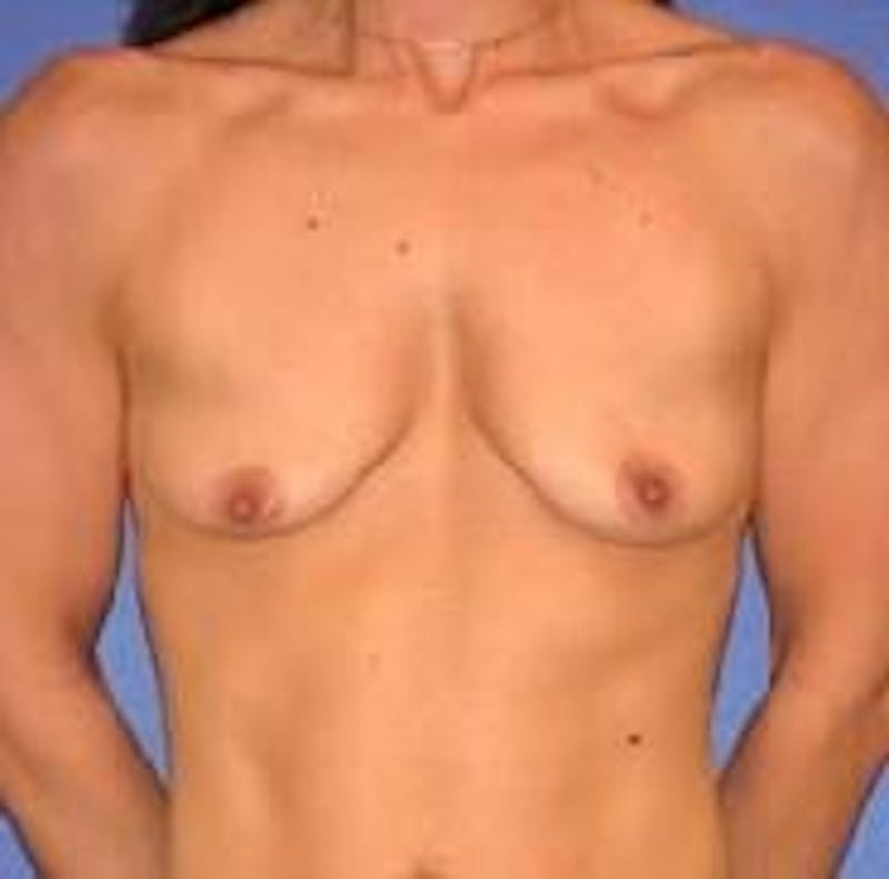 Breast Augmentation Before & After Gallery - Patient 90006630 - Image 1
