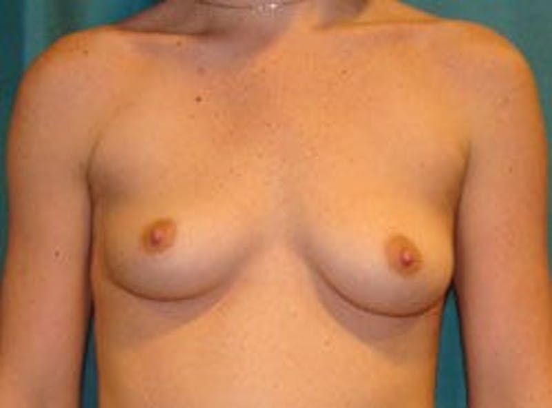 Breast Augmentation Before & After Gallery - Patient 90006656 - Image 1