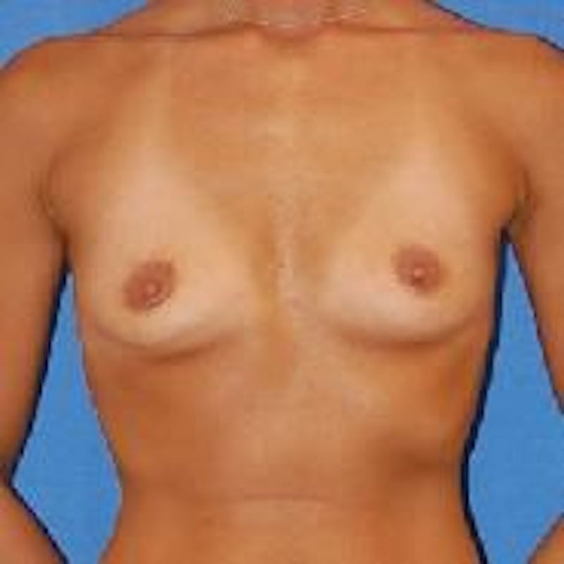 Breast Augmentation Before & After Gallery - Patient 90027106 - Image 1