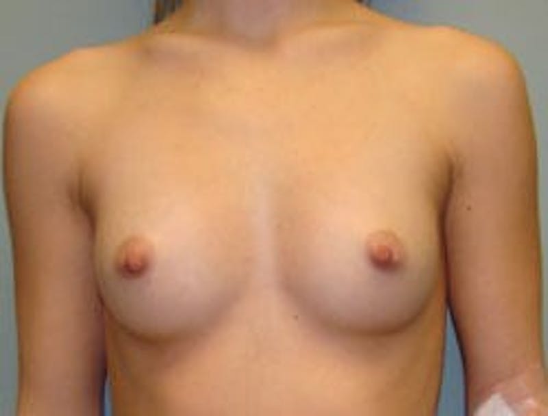 Breast Augmentation Before & After Gallery - Patient 90027174 - Image 1
