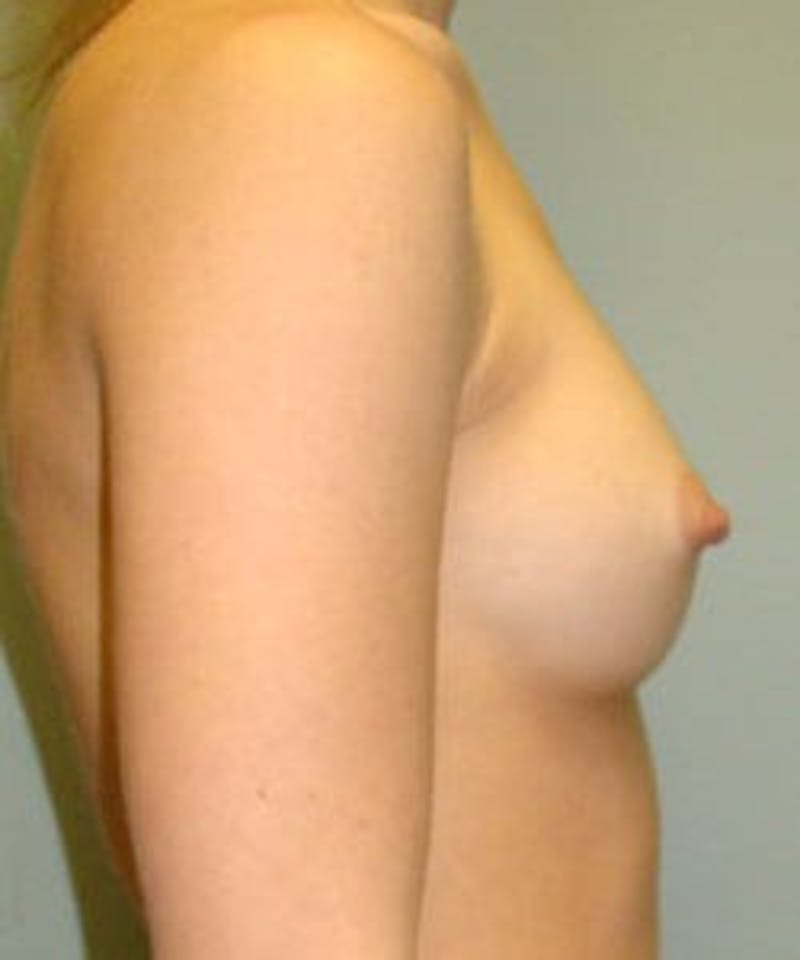 Breast Augmentation Before & After Gallery - Patient 90027174 - Image 3