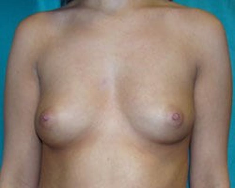 Breast Augmentation Before & After Gallery - Patient 90027188 - Image 1