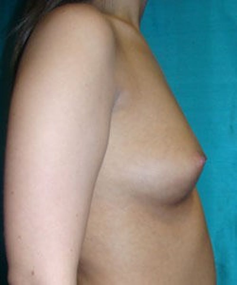 Breast Augmentation Before & After Gallery - Patient 90027188 - Image 3