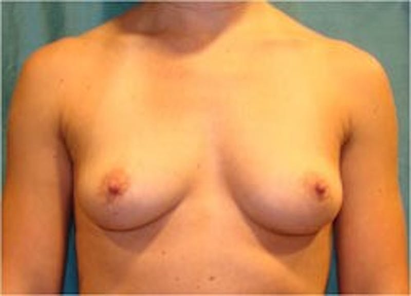 Breast Augmentation Before & After Gallery - Patient 90027190 - Image 1