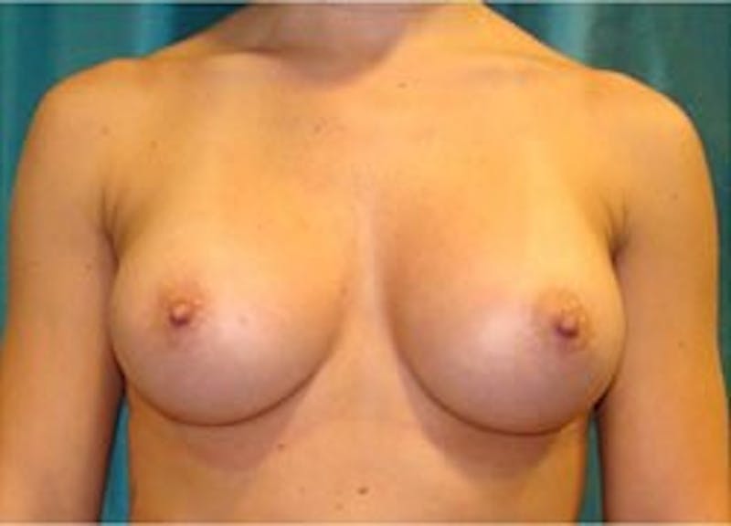 Breast Augmentation Before & After Gallery - Patient 90027190 - Image 2