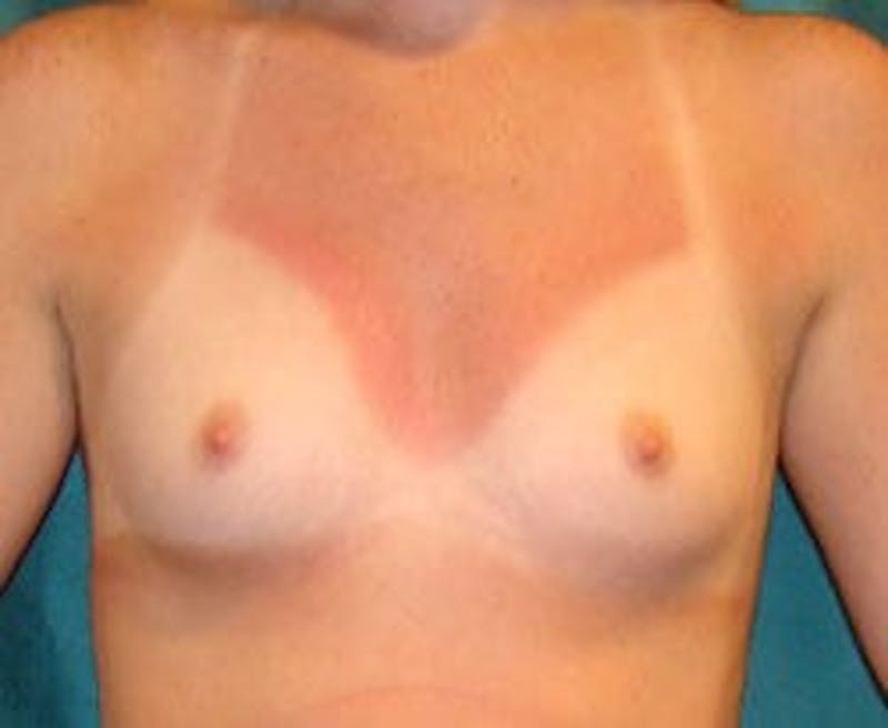 Breast Augmentation Before & After Gallery - Patient 90027197 - Image 1