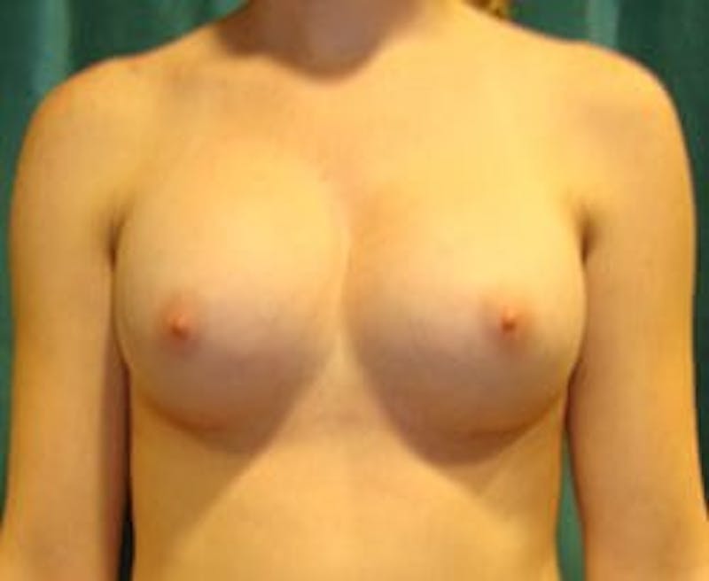 Breast Augmentation Before & After Gallery - Patient 90027197 - Image 2