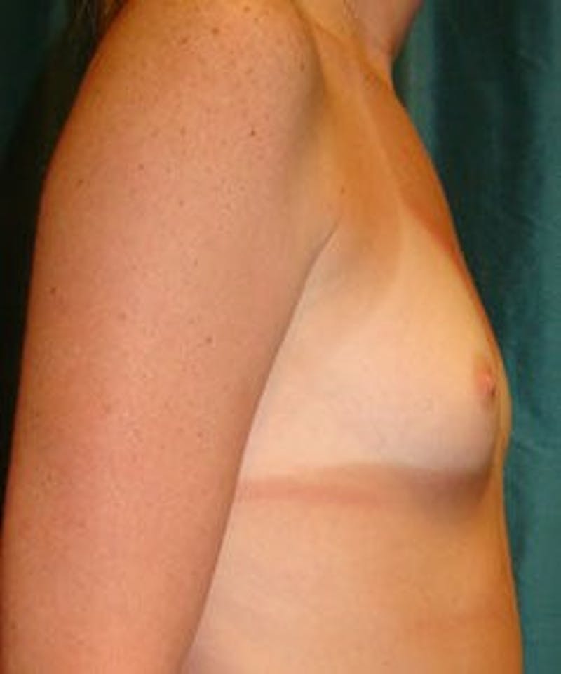 Breast Augmentation Before & After Gallery - Patient 90027197 - Image 3