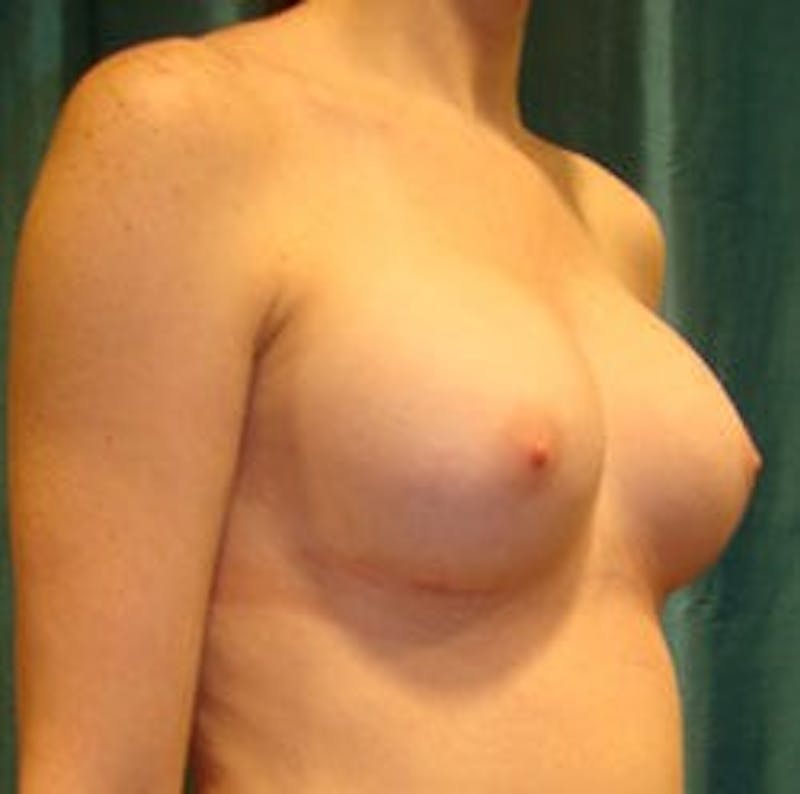 Breast Augmentation Before & After Gallery - Patient 90027197 - Image 6