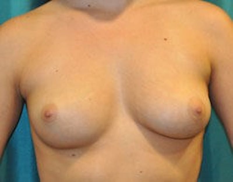Breast Augmentation Before & After Gallery - Patient 90027199 - Image 1