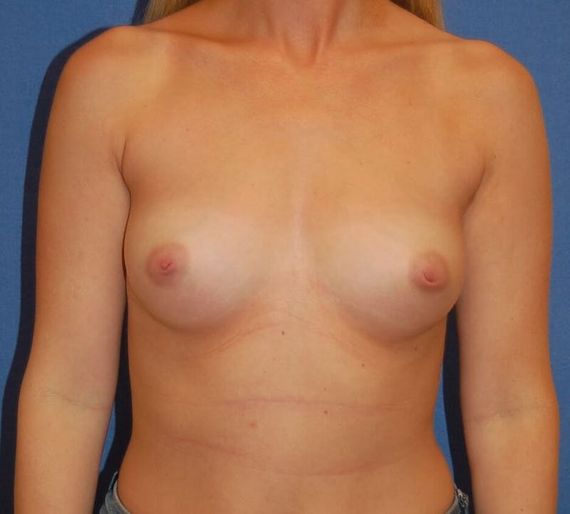 Breast Augmentation Before & After Gallery - Patient 90027209 - Image 1