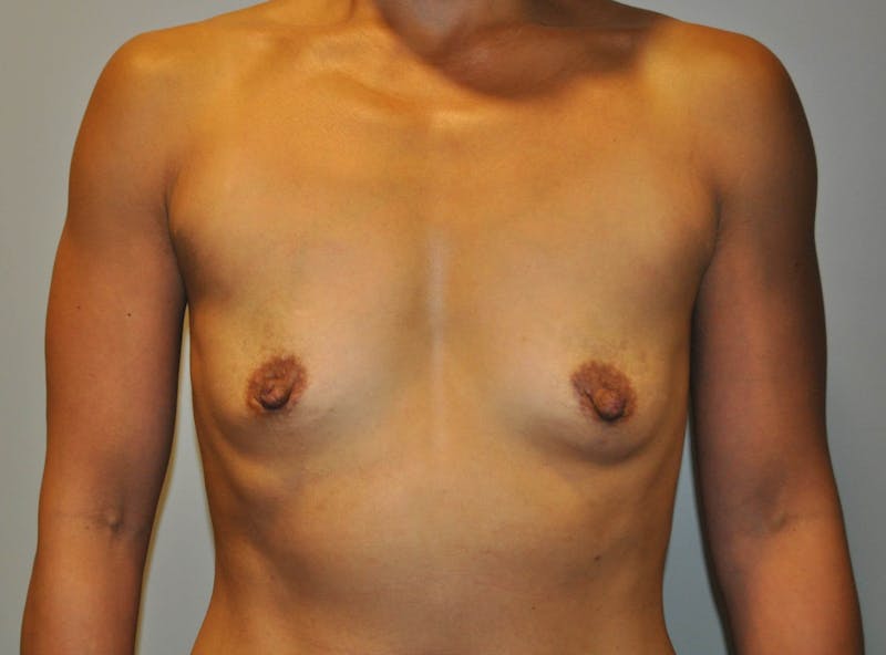 Breast Augmentation Before & After Gallery - Patient 90027239 - Image 1