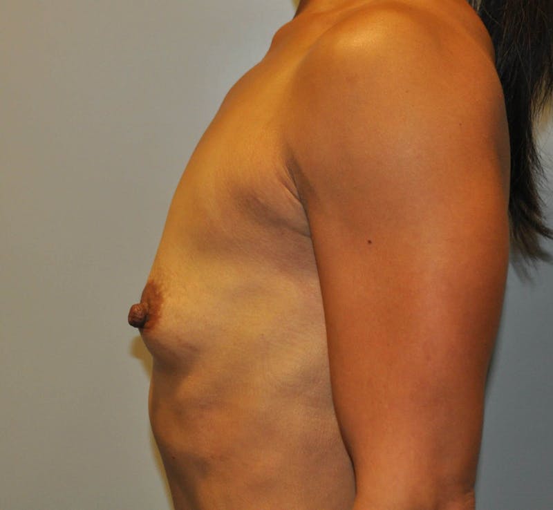Breast Augmentation Before & After Gallery - Patient 90027239 - Image 3