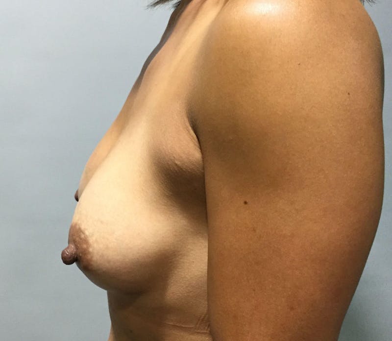 Breast Augmentation Before & After Gallery - Patient 90027239 - Image 4