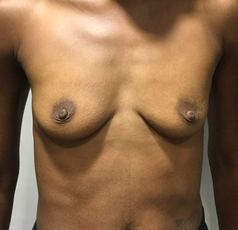 Breast Augmentation Before & After Gallery - Patient 90027243 - Image 1