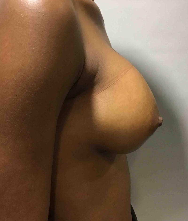 Breast Augmentation Before & After Gallery - Patient 90027243 - Image 4
