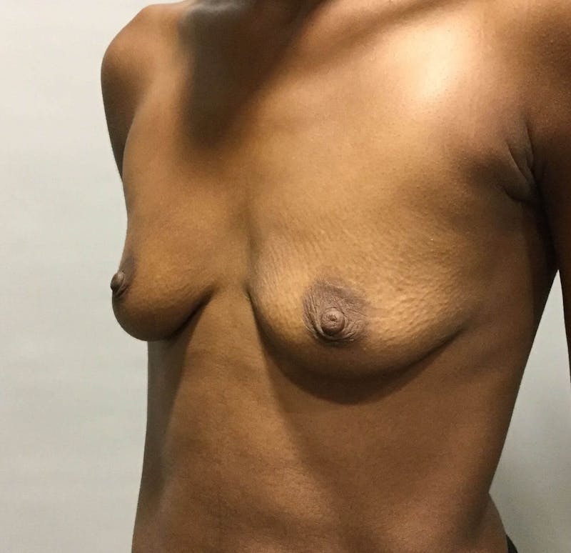 Breast Augmentation Before & After Gallery - Patient 90027243 - Image 5