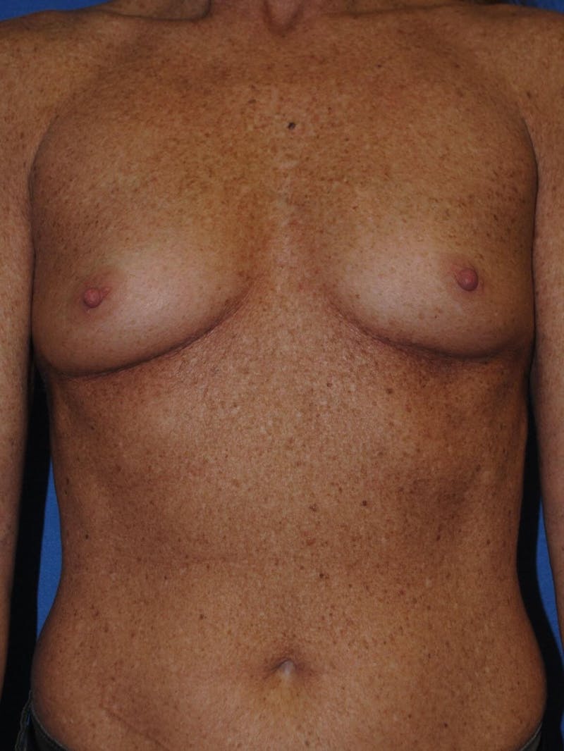 Breast Augmentation Gallery - Patient 90027245 - Image 1