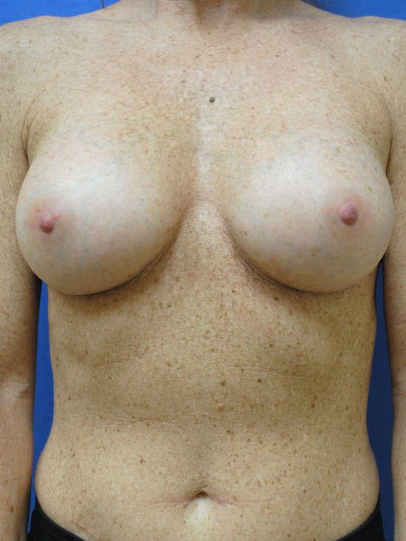Breast Augmentation Before & After Gallery - Patient 90027245 - Image 2