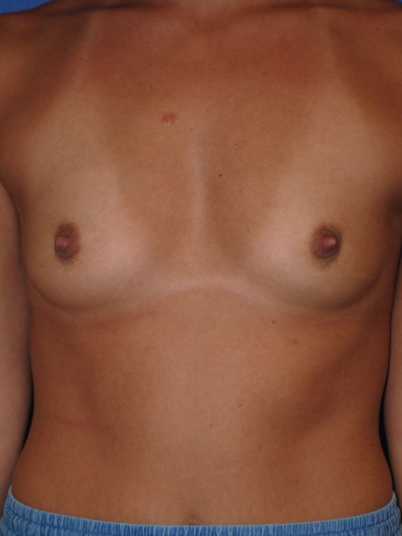 Breast Augmentation Before & After Gallery - Patient 90027246 - Image 1