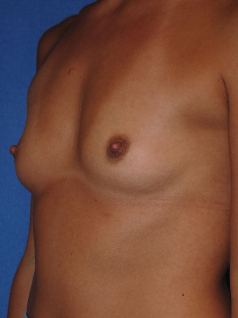 Breast Augmentation Gallery - Patient 90027246 - Image 3