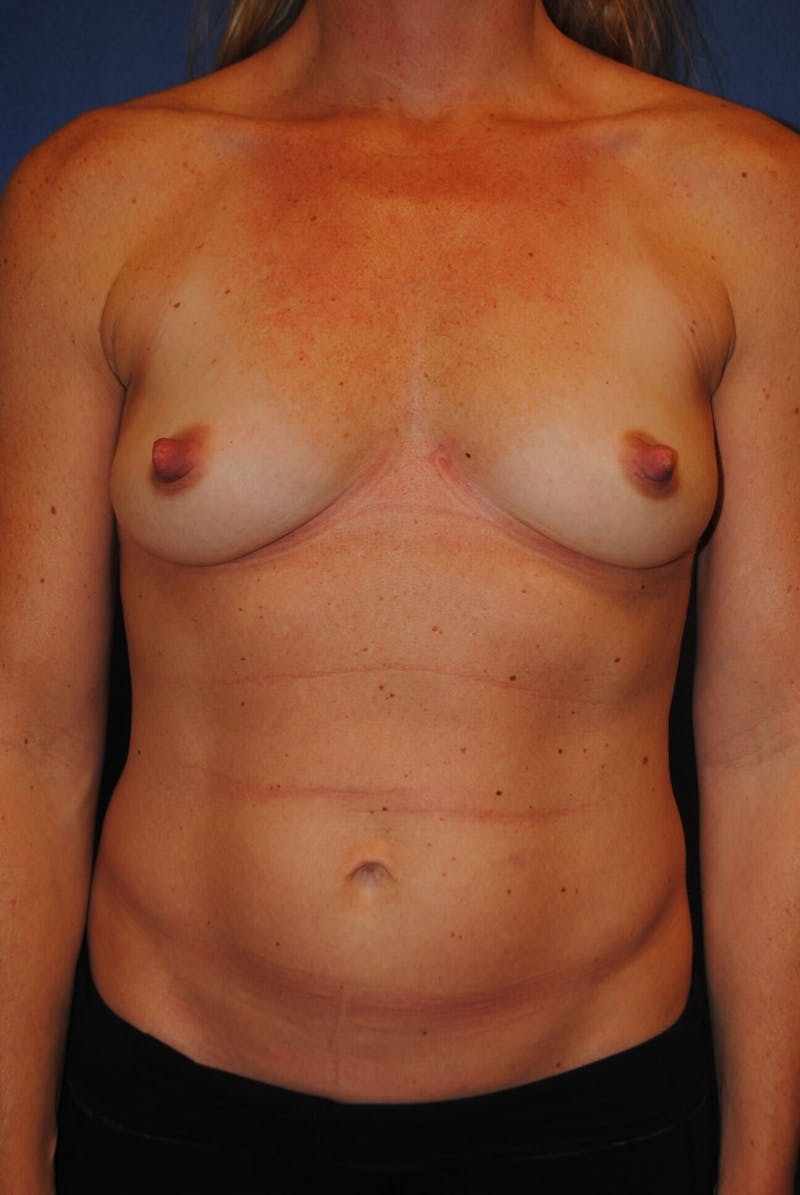 Breast Augmentation Before & After Gallery - Patient 90027275 - Image 1