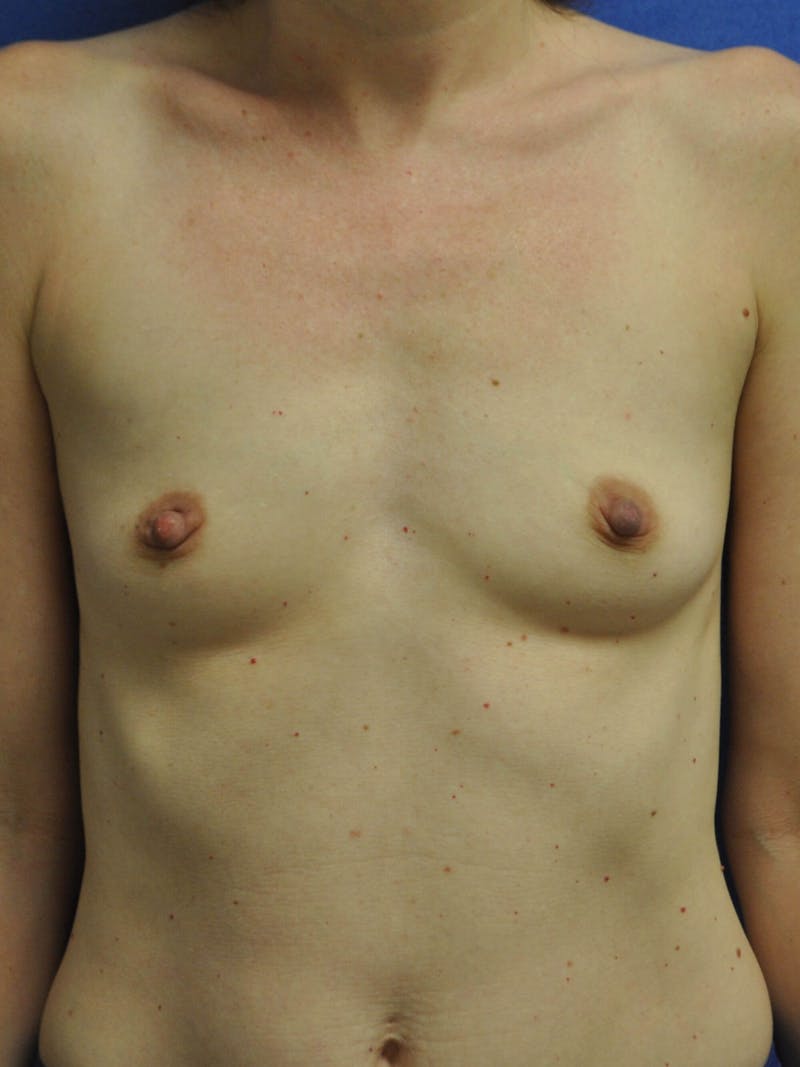 Breast Augmentation Before & After Gallery - Patient 90027281 - Image 1